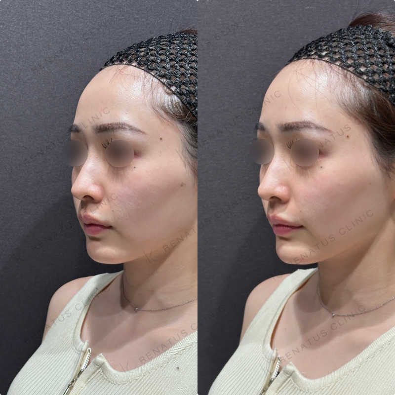 顎ヒアルロン酸ダイヤモンドフィール症例写真