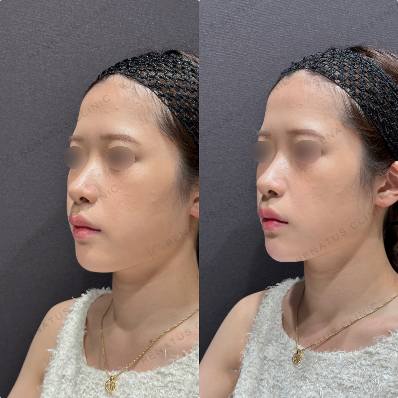 顎ヒアルロン酸ダイヤモンドフィール症例写真