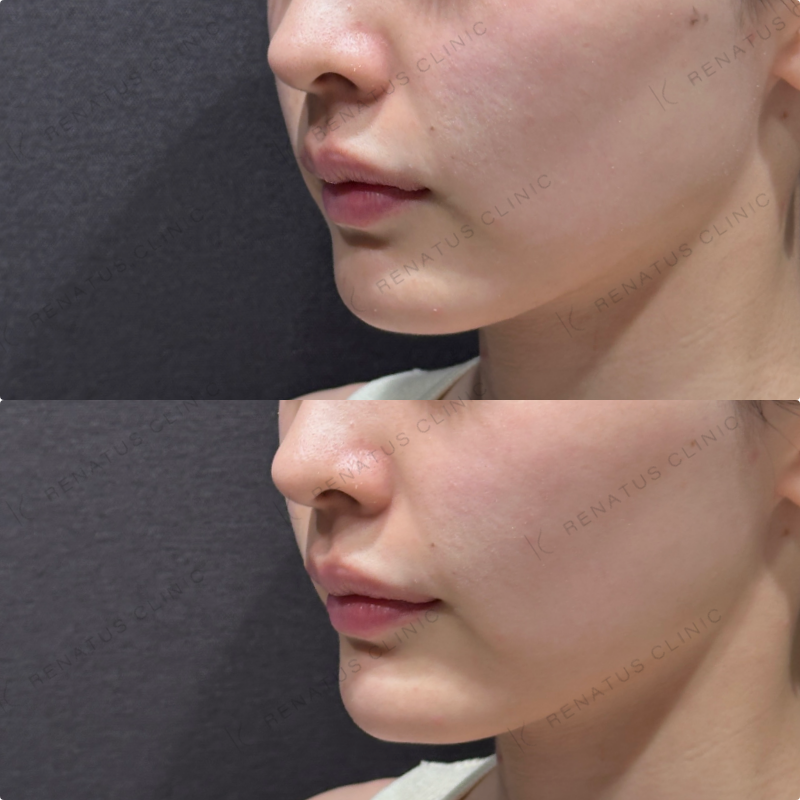 顎ヒアルロン酸ダイヤモンドフィール症例写真