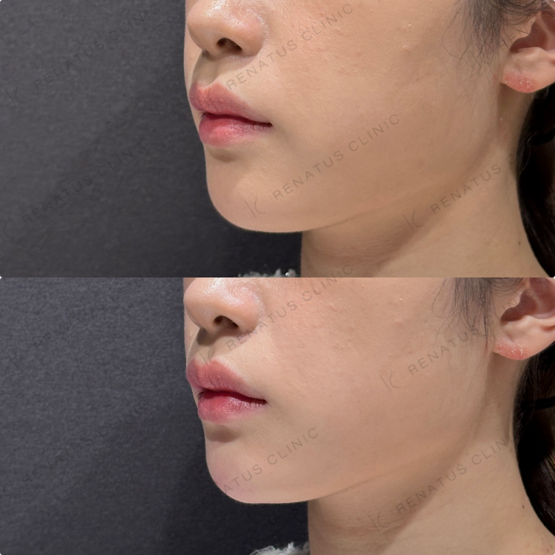 顎ヒアルロン酸ダイヤモンドフィール症例写真