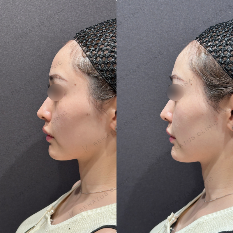 顎ヒアルロン酸ダイヤモンドフィール症例写真