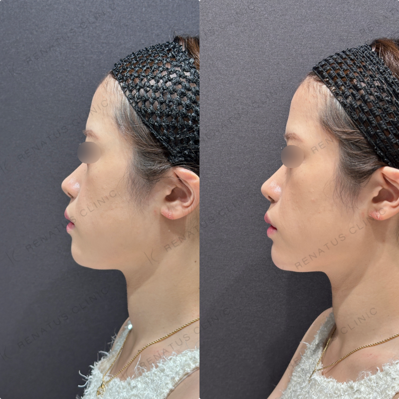 顎ヒアルロン酸ダイヤモンドフィール症例写真