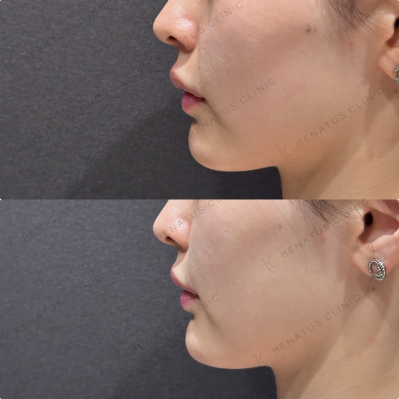 顎ヒアルロン酸ダイヤモンドフィール症例写真