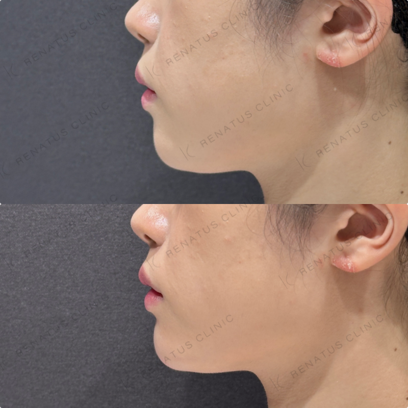 顎ヒアルロン酸ダイヤモンドフィール症例写真