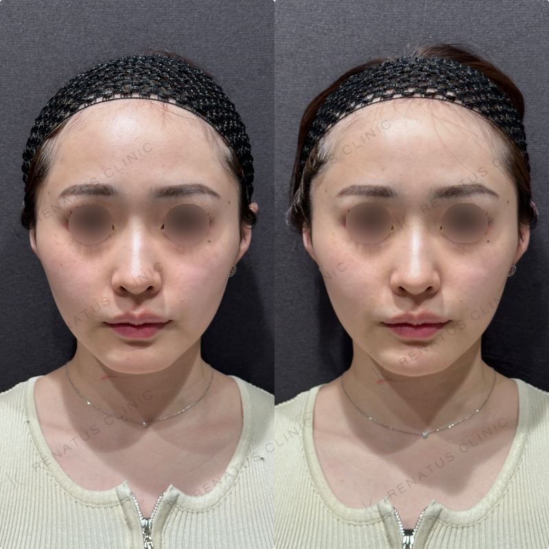 顎ヒアルロン酸ダイヤモンドフィール症例写真