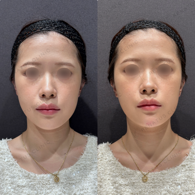 顎ヒアルロン酸ダイヤモンドフィール症例写真
