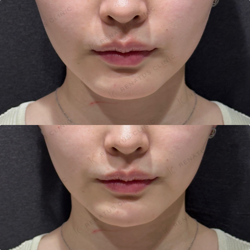 顎ヒアルロン酸ダイヤモンドフィール症例写真