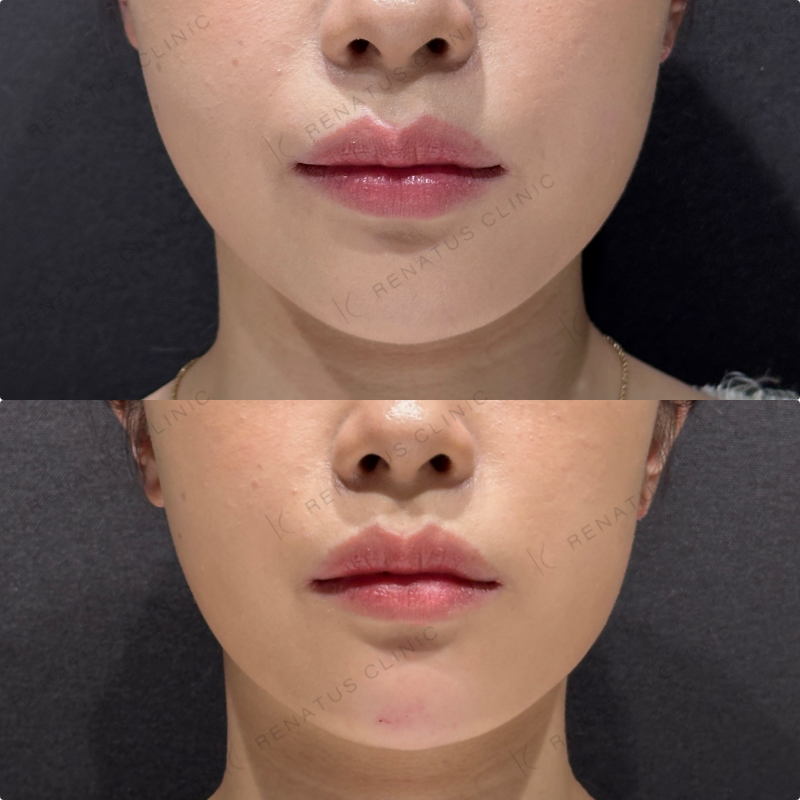 顎ヒアルロン酸ダイヤモンドフィール症例写真