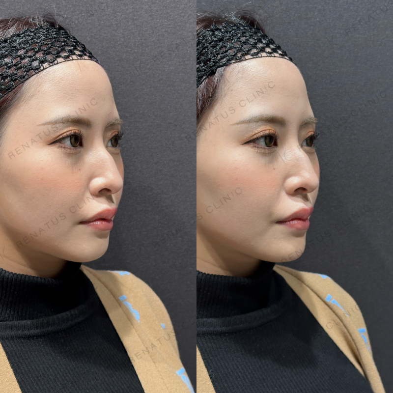 顎ヒアルロン酸ボラックス症例写真