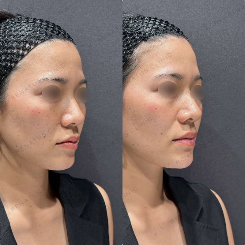 顎ヒアルロン酸ボラックス症例写真