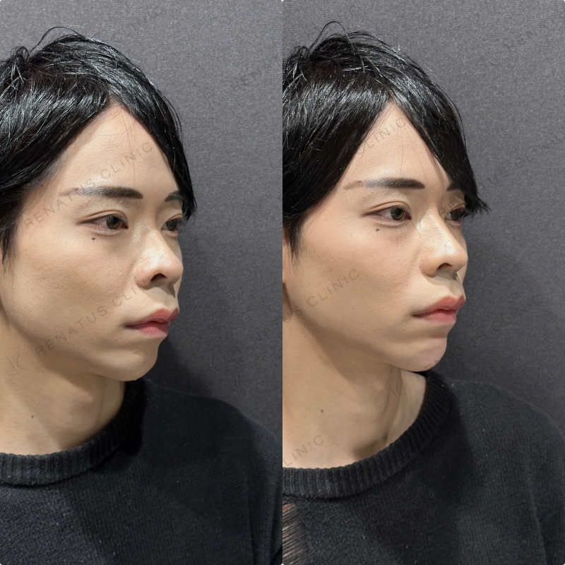 顎ヒアルロン酸ボラックス症例写真