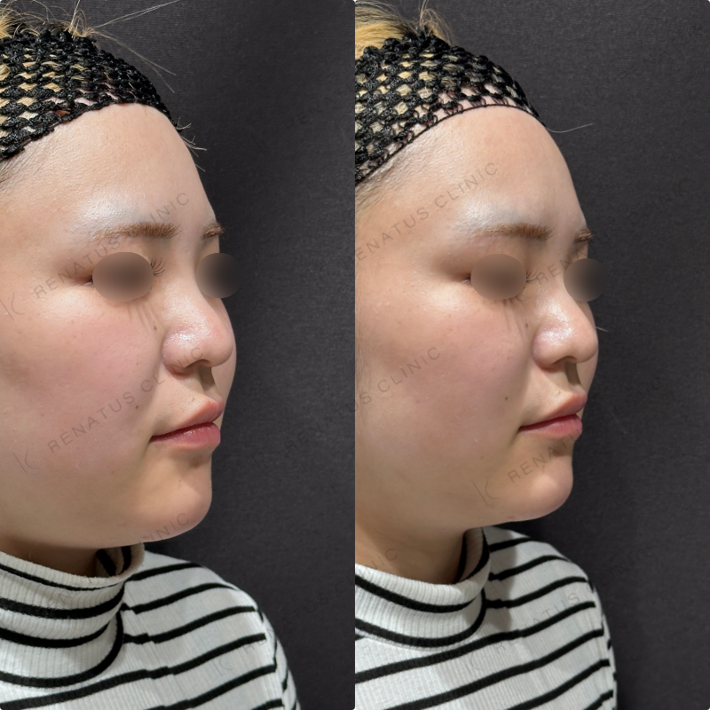 顎ヒアルロン酸ボラックス症例写真