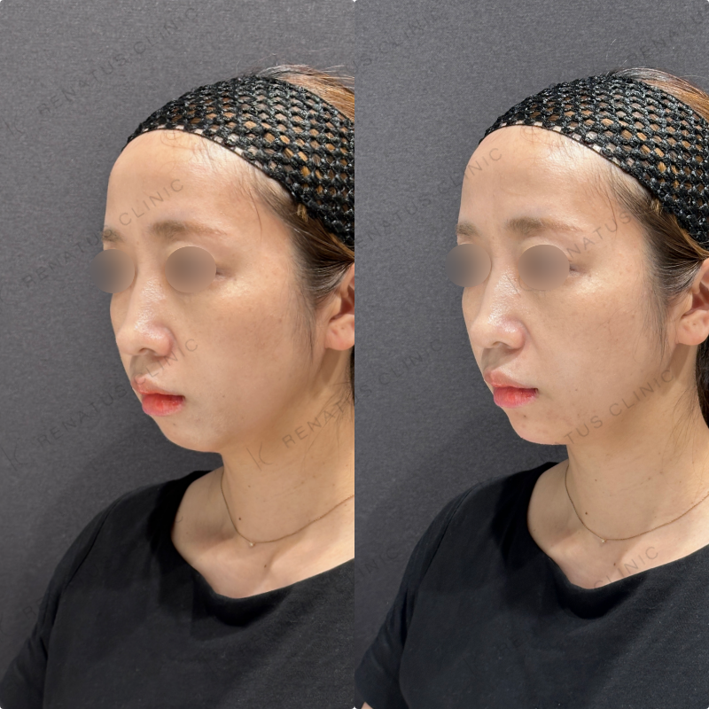 顎ヒアルロン酸ボラックス症例写真