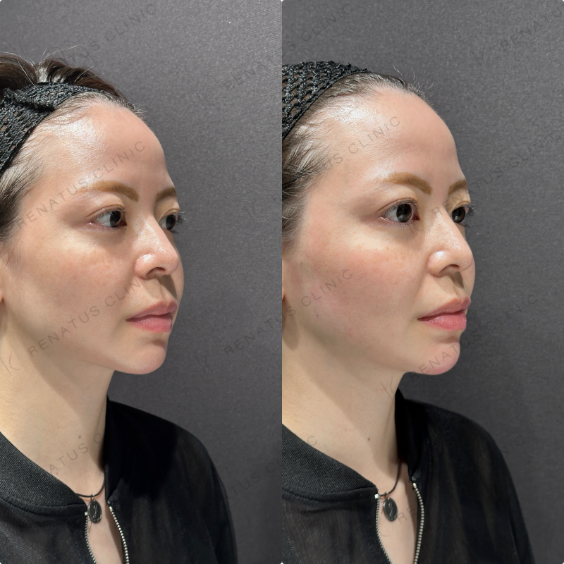 顎ヒアルロン酸ボラックス症例写真