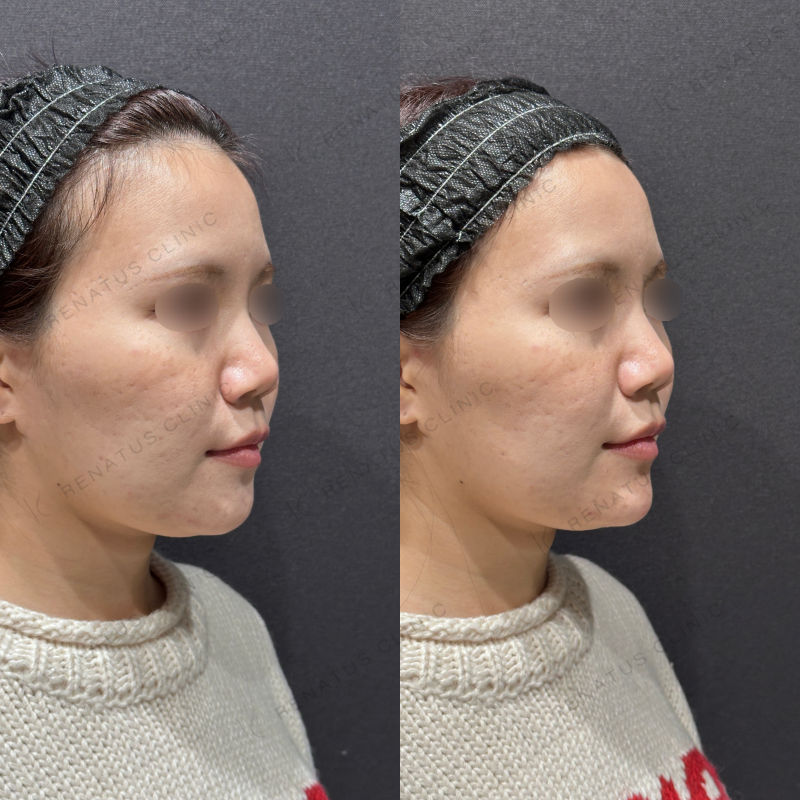 顎ヒアルロン酸ボラックス症例写真