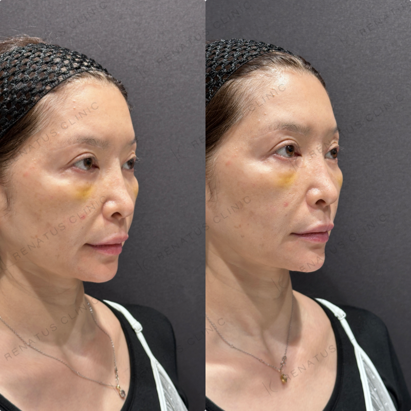 顎ヒアルロン酸ボラックス症例写真