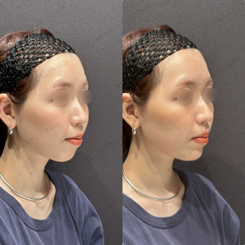 顎ヒアルロン酸ボラックス症例写真