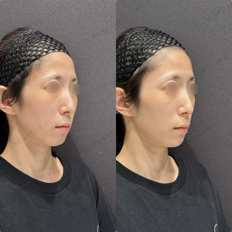 顎ヒアルロン酸ボラックス症例写真