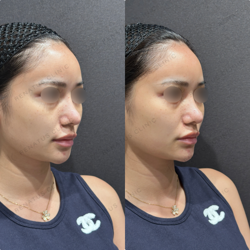 顎ヒアルロン酸ボラックス症例写真