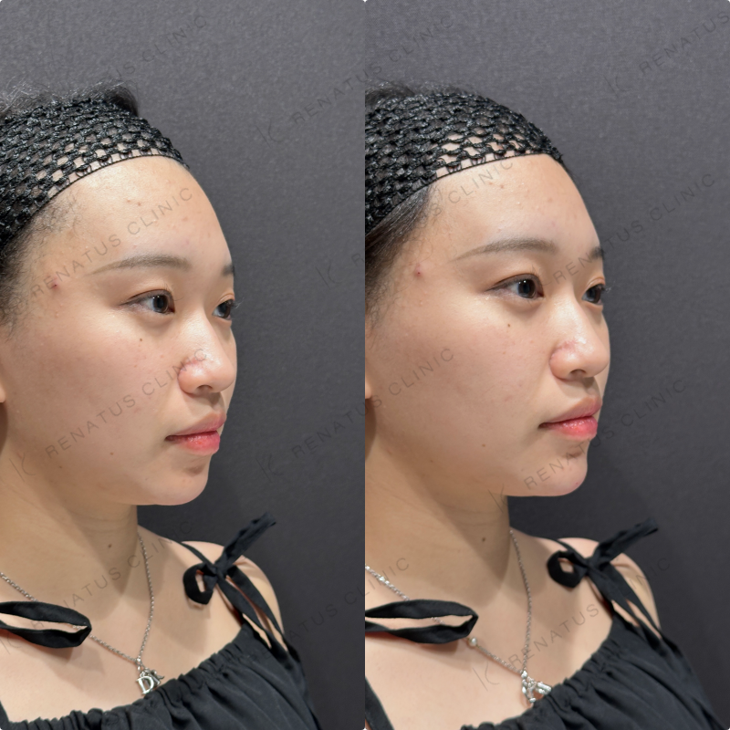 顎ヒアルロン酸ボラックス症例写真