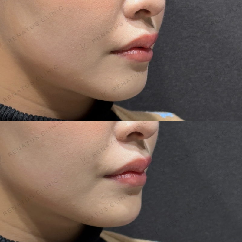 顎ヒアルロン酸ボラックス症例写真