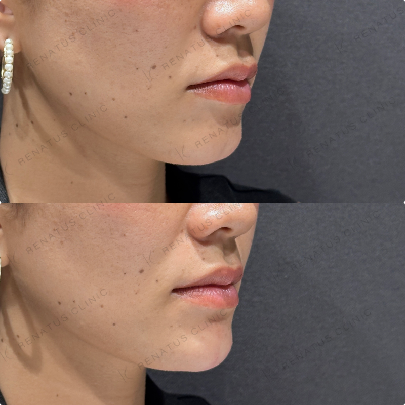 顎ヒアルロン酸ボラックス症例写真