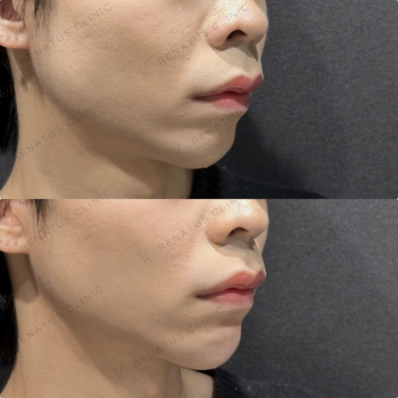 顎ヒアルロン酸ボラックス症例写真