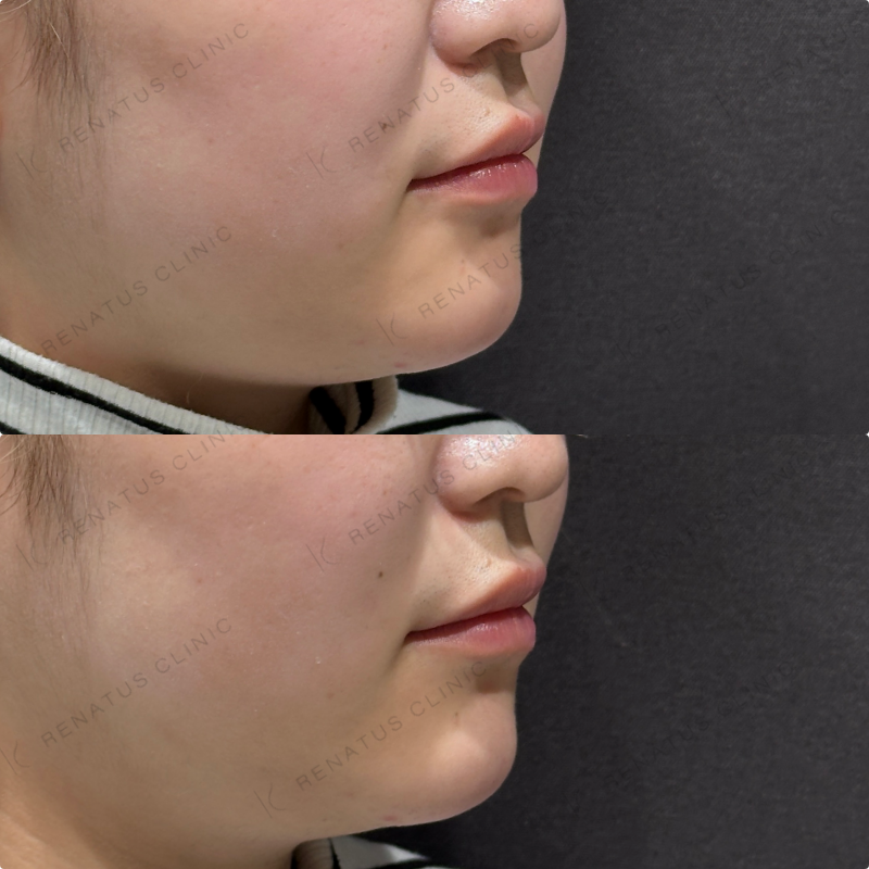 顎ヒアルロン酸ボラックス症例写真