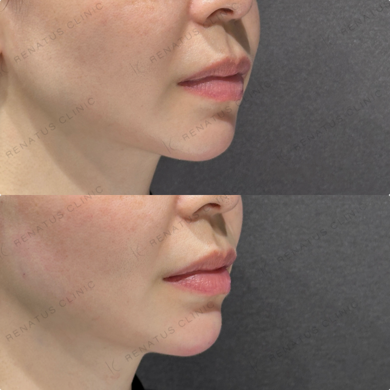 顎ヒアルロン酸ボラックス症例写真