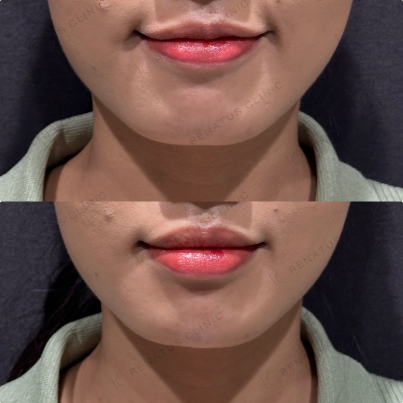 顎ヒアルロン酸ボラックス症例写真