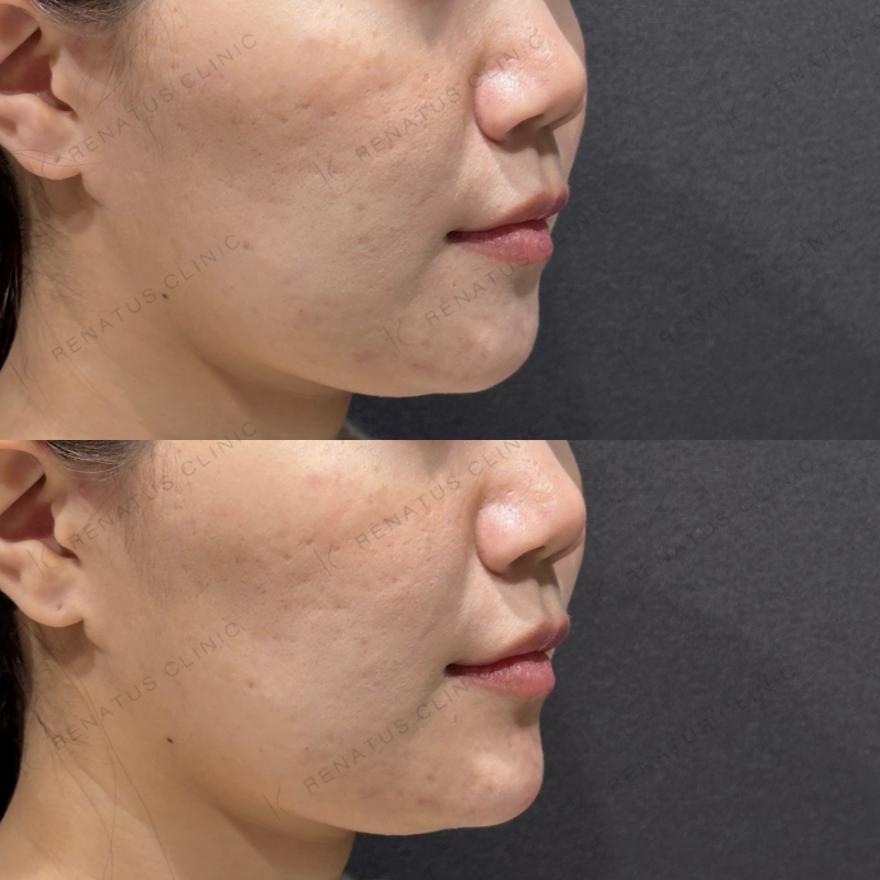 顎ヒアルロン酸ボラックス症例写真