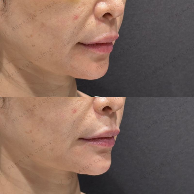 顎ヒアルロン酸ボラックス症例写真