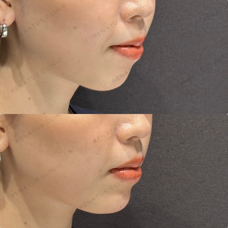 顎ヒアルロン酸ボラックス症例写真