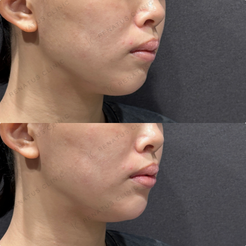 顎ヒアルロン酸ボラックス症例写真