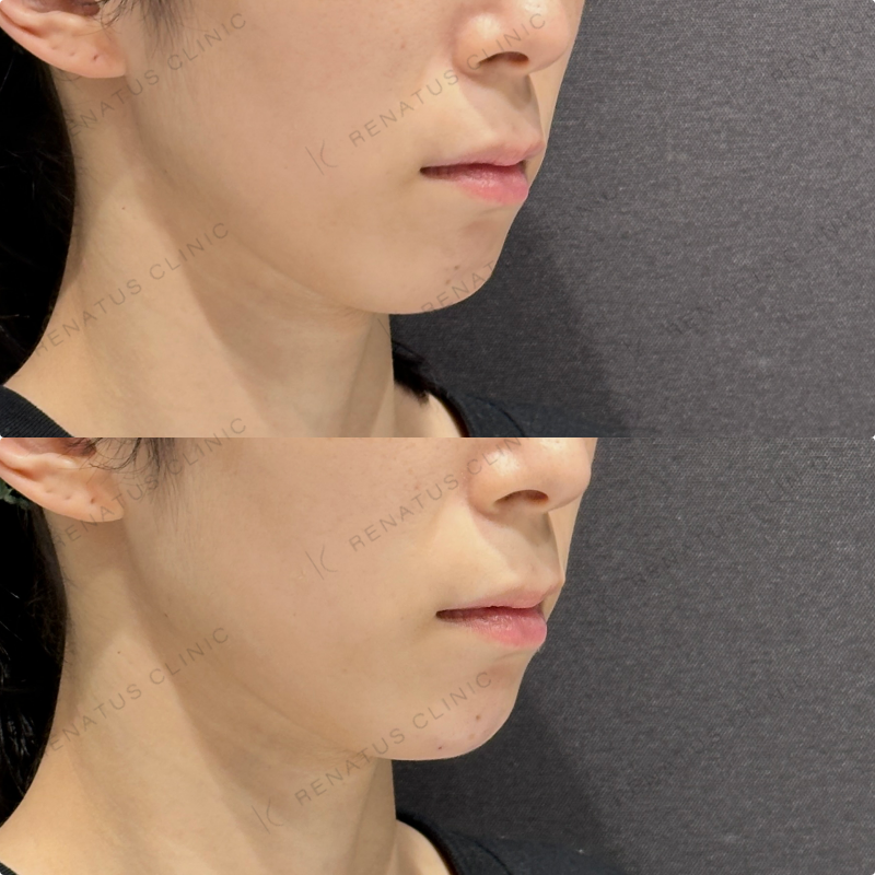 顎ヒアルロン酸ボラックス症例写真