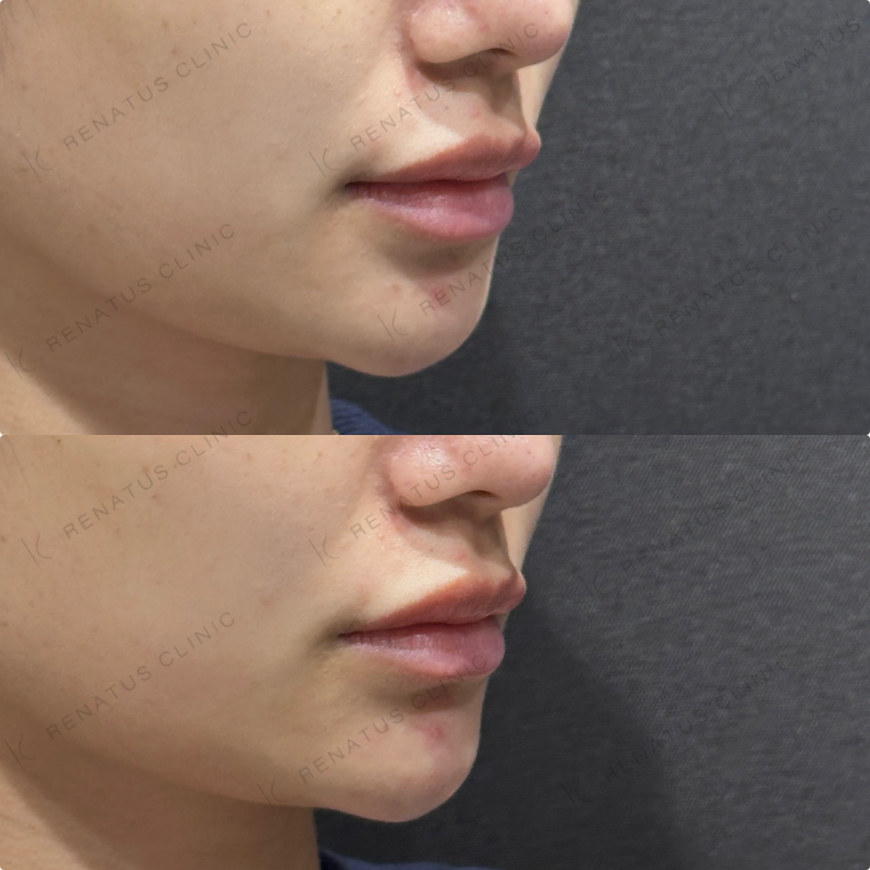 顎ヒアルロン酸ボラックス症例写真