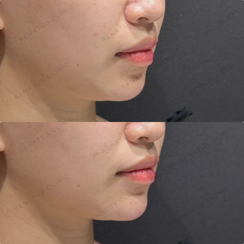 顎ヒアルロン酸ボラックス症例写真