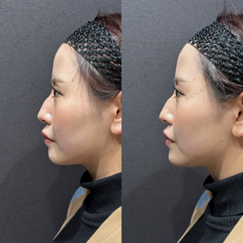 顎ヒアルロン酸ボラックス症例写真