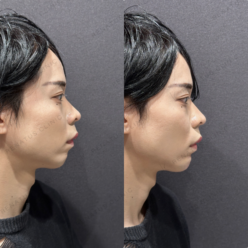 顎ヒアルロン酸ボラックス症例写真