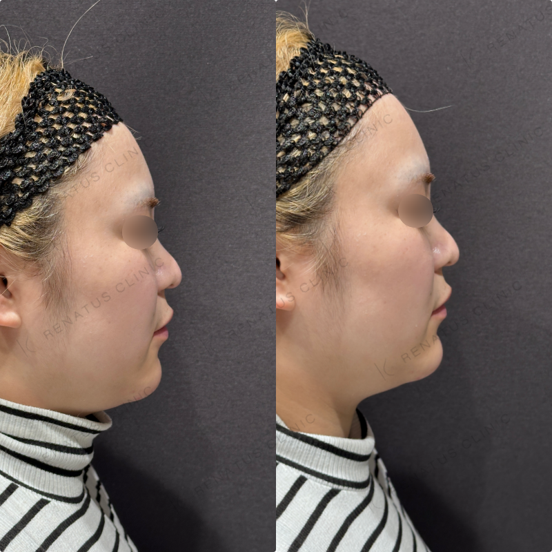 顎ヒアルロン酸ボラックス症例写真