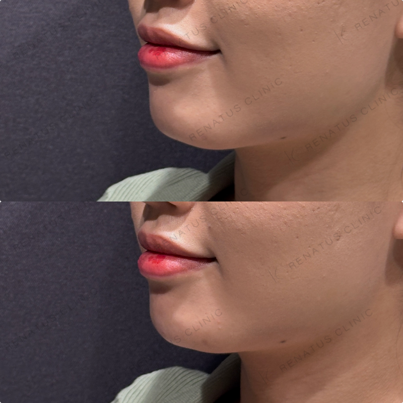 顎ヒアルロン酸ボラックス症例写真