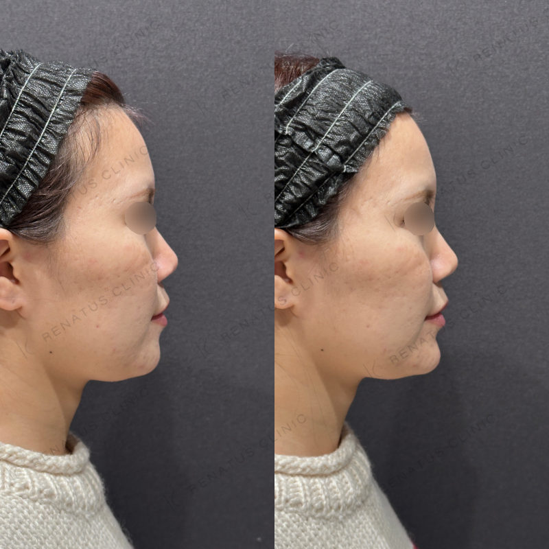 顎ヒアルロン酸ボラックス症例写真