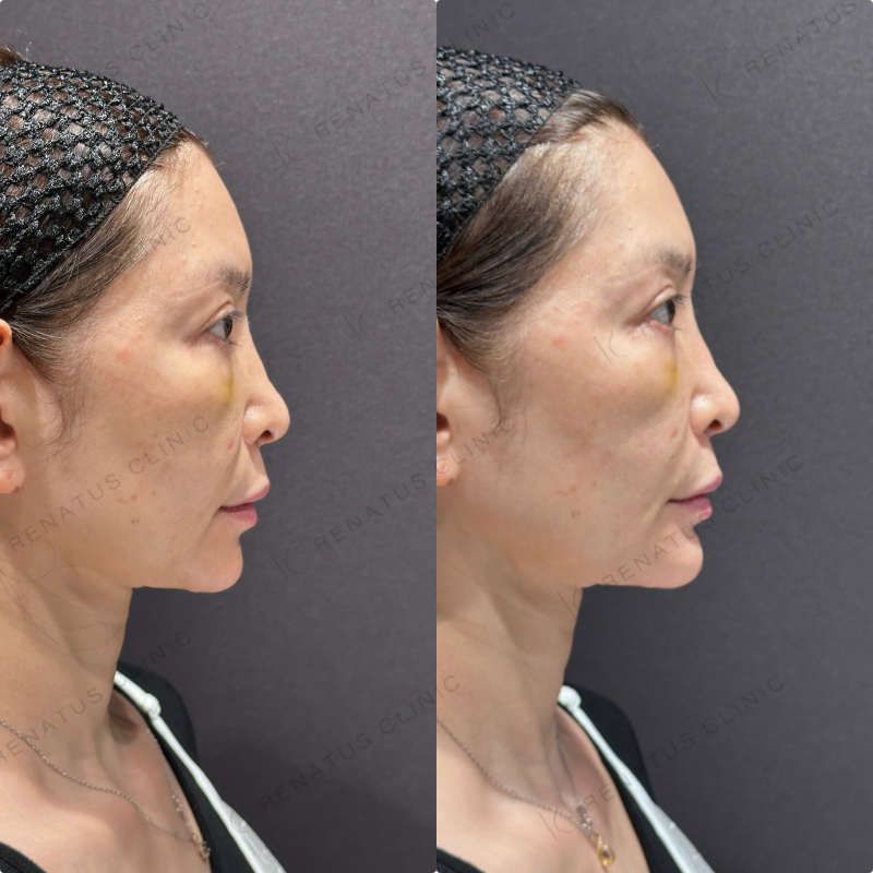 顎ヒアルロン酸ボラックス症例写真