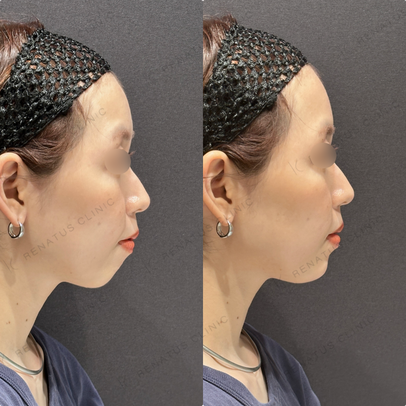 顎ヒアルロン酸ボラックス症例写真