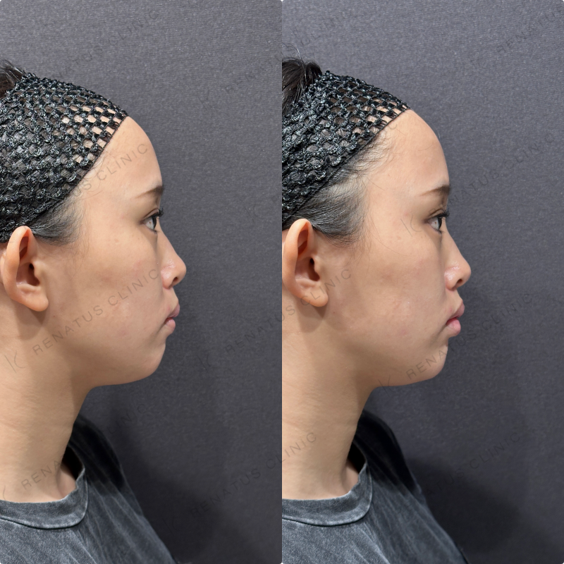 顎ヒアルロン酸ボラックス症例写真