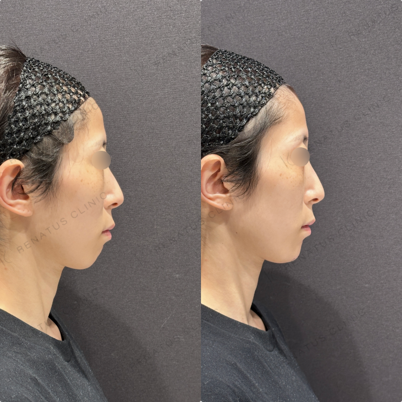 顎ヒアルロン酸ボラックス症例写真