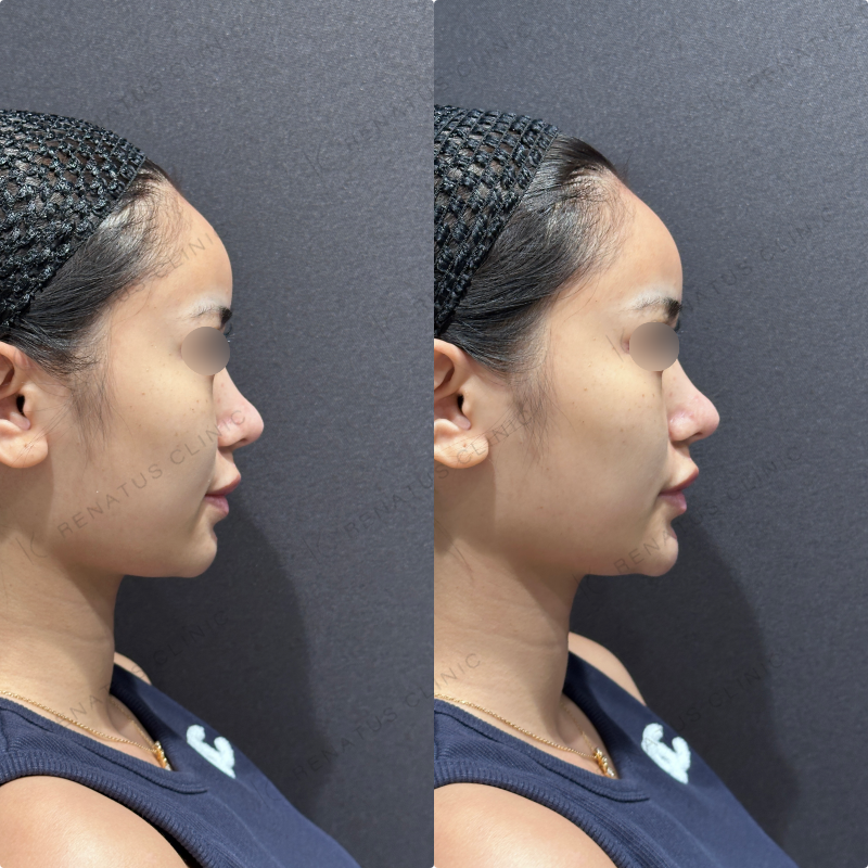 顎ヒアルロン酸ボラックス症例写真