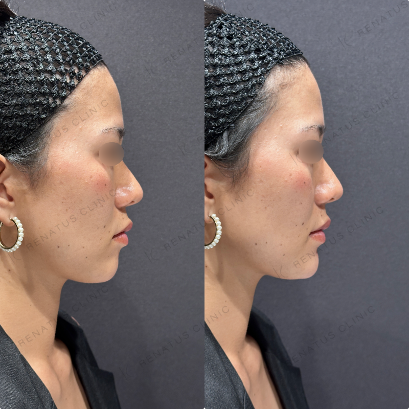 顎ヒアルロン酸ボラックス症例写真