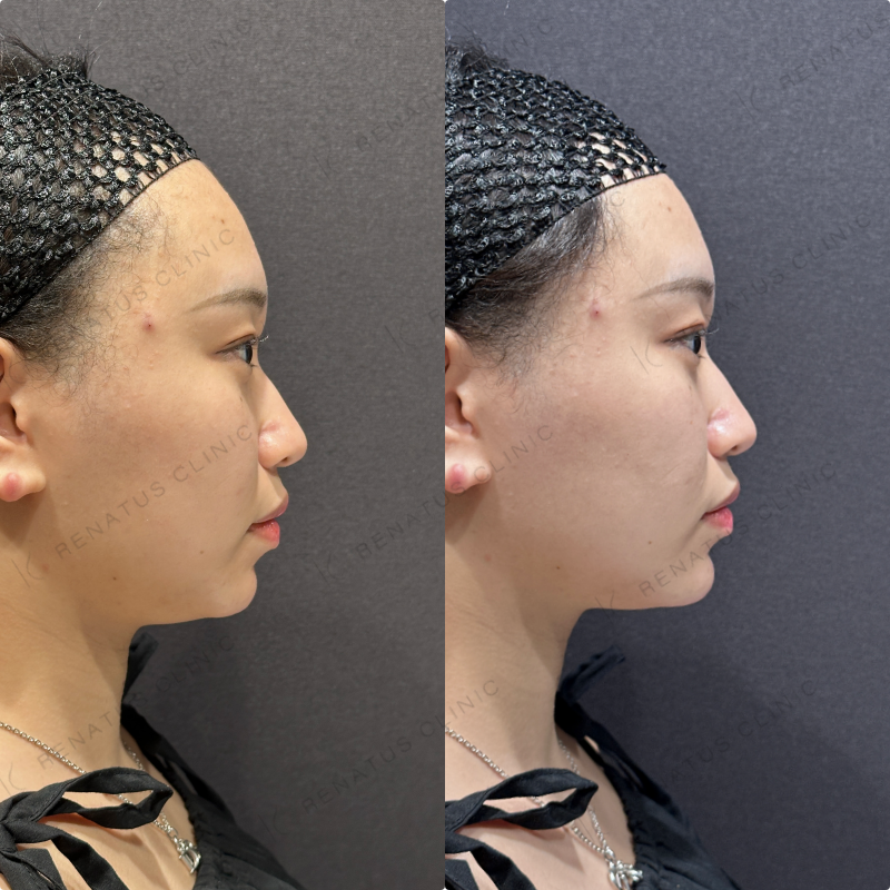 顎ヒアルロン酸ボラックス症例写真