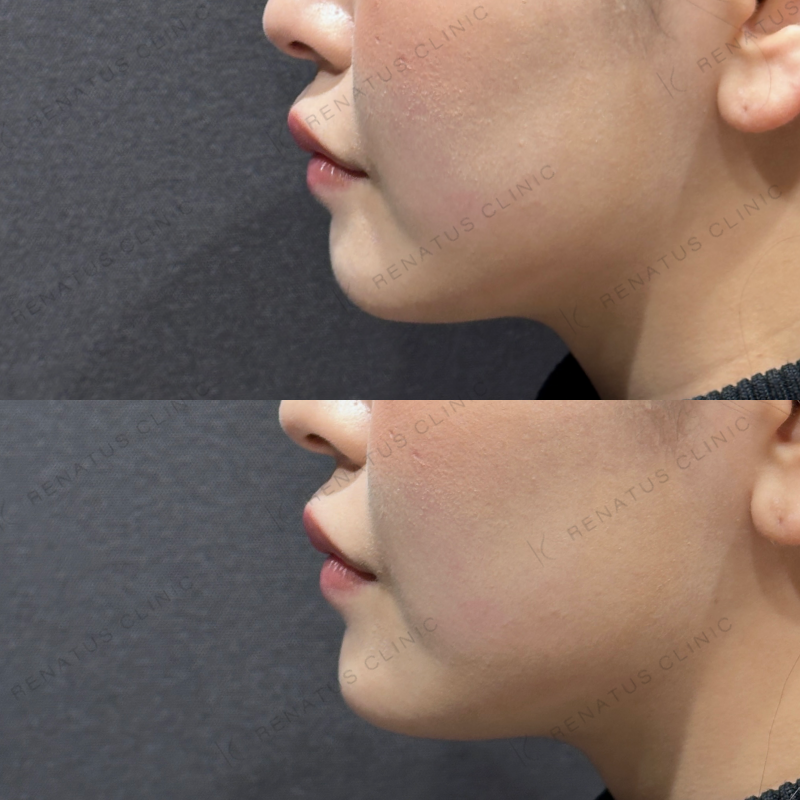 顎ヒアルロン酸ボラックス症例写真